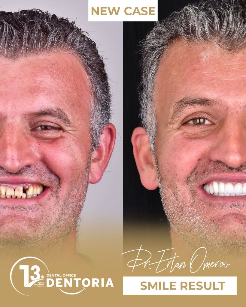 Before and after smile restoration at Dentoria
